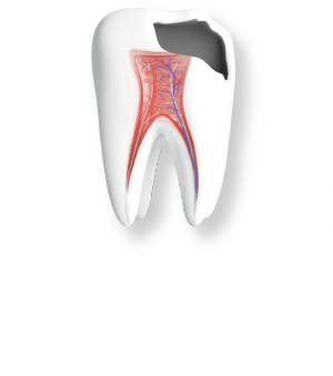 重度の虫歯からの回復
