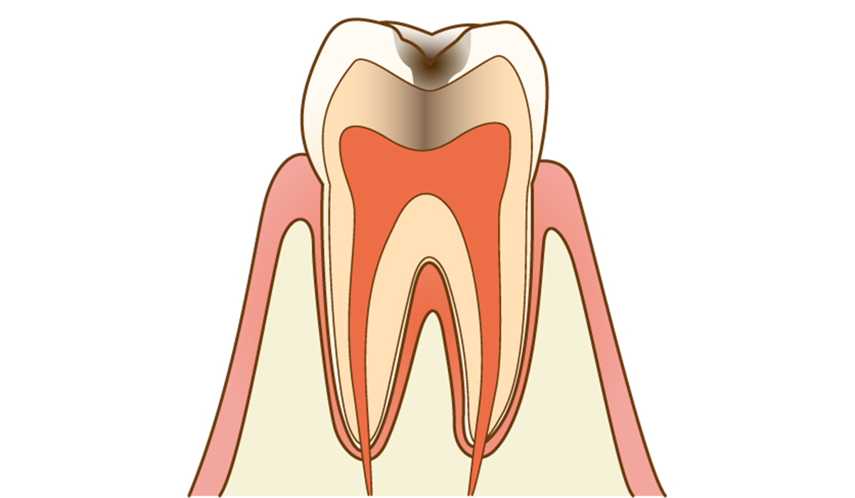 進行した虫歯