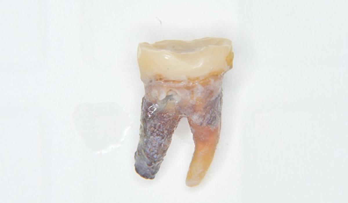 2.歯石の種類と特徴を理解する