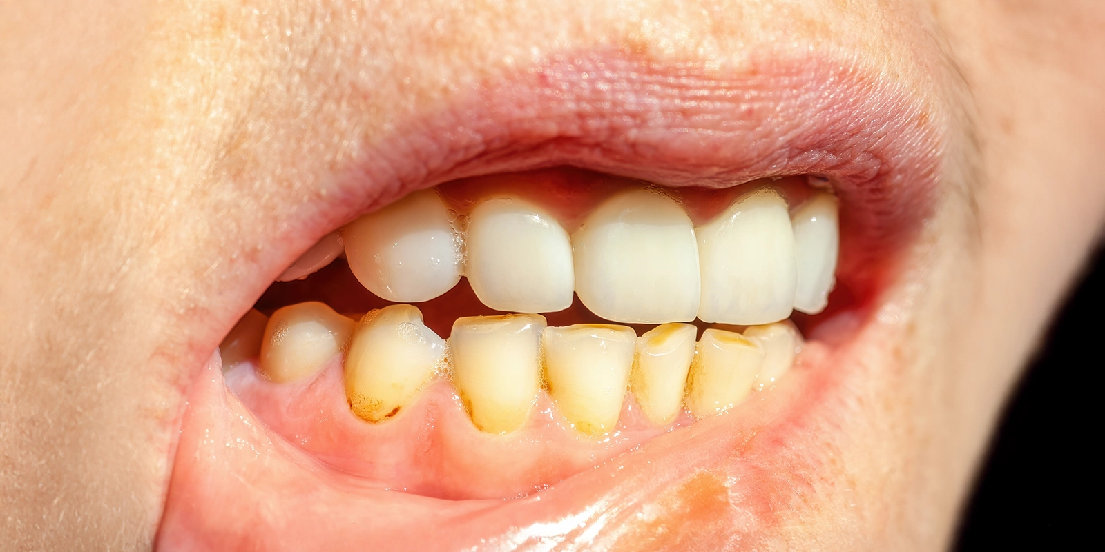 2.歯石の種類と特徴を理解する