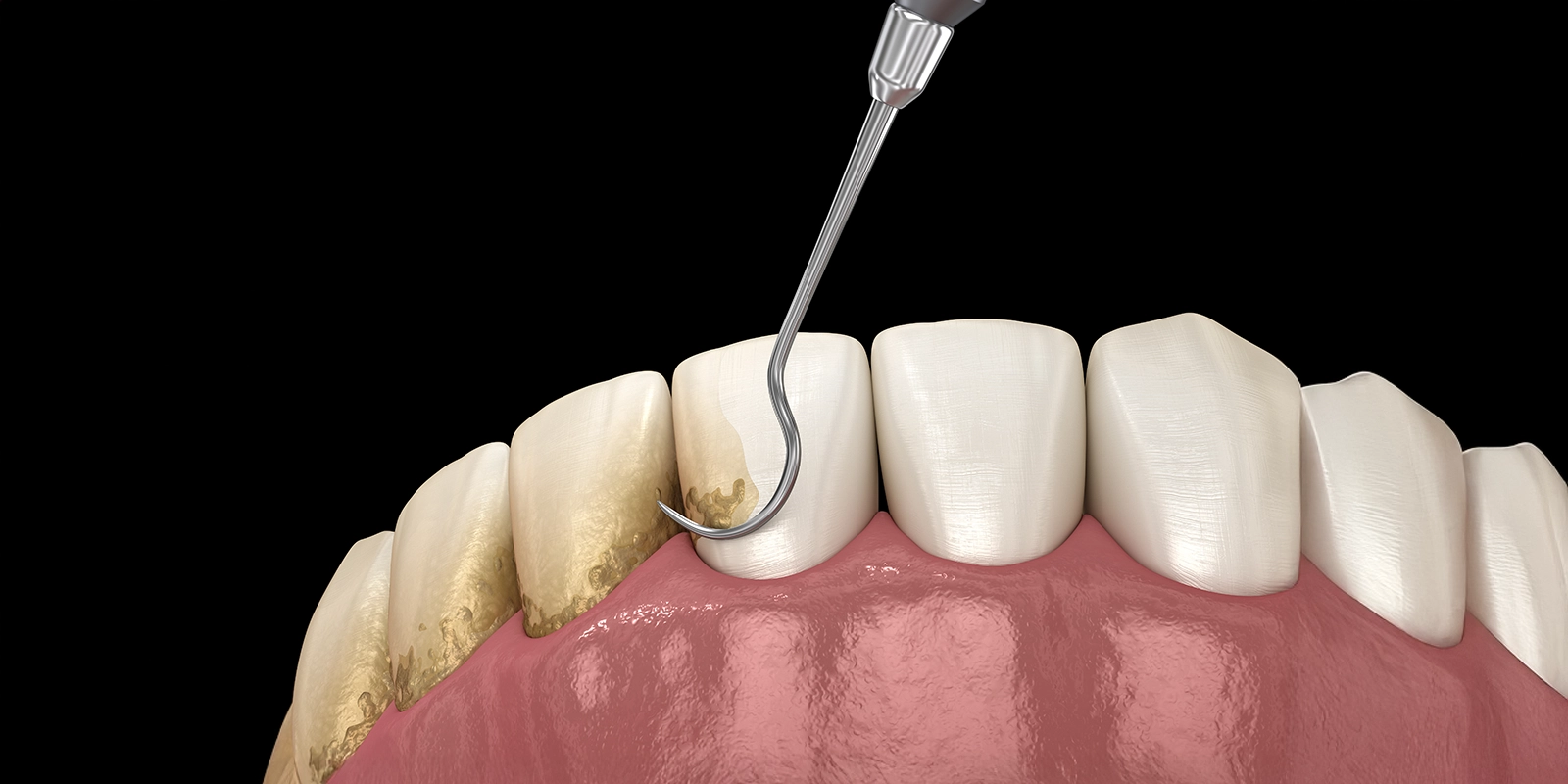 3.歯肉縁上歯石除去（スケーリング）とは