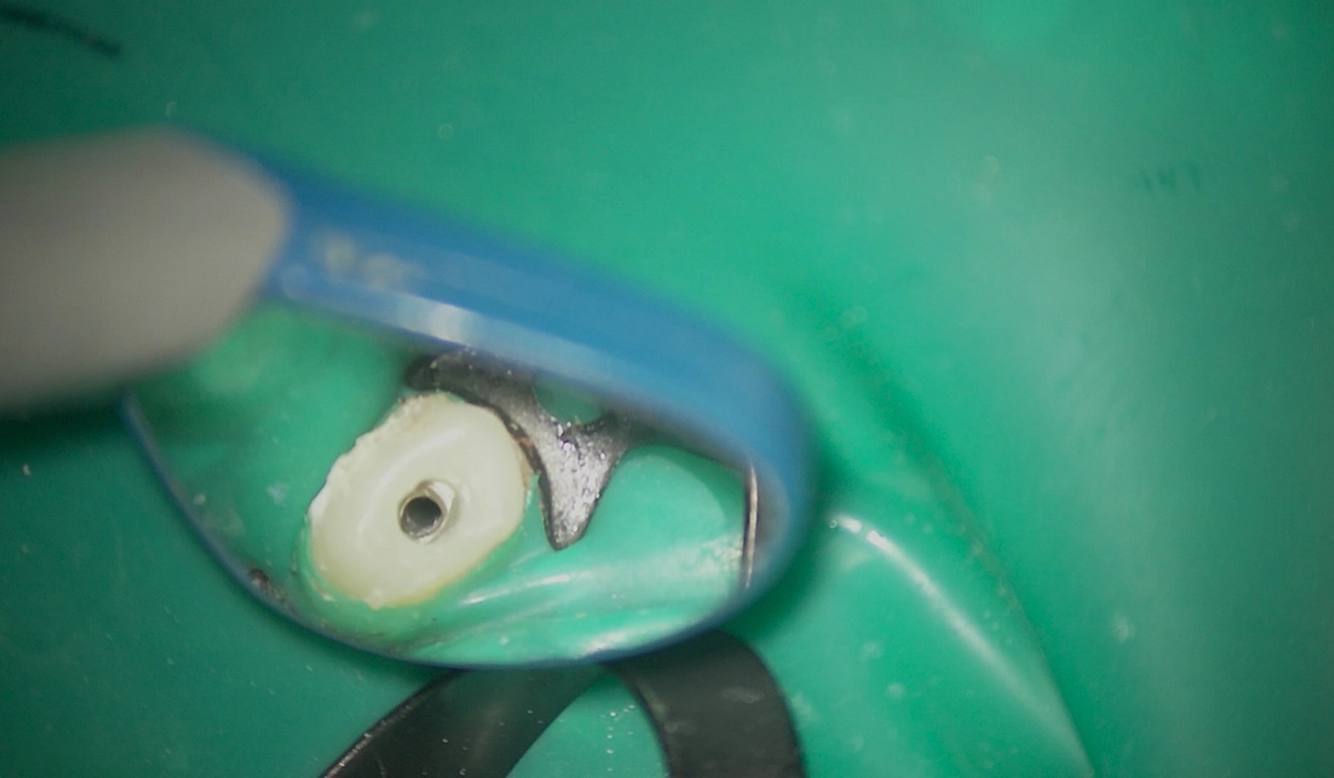 【根管治療中・根管治療後】