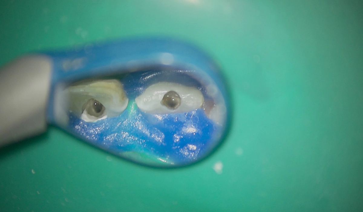 【根管治療中・根管治療後】