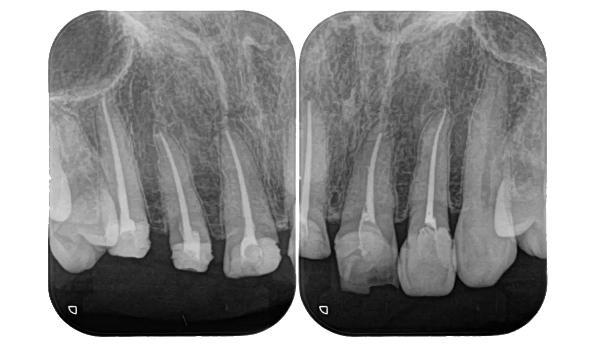 【根管治療中・根管治療後】