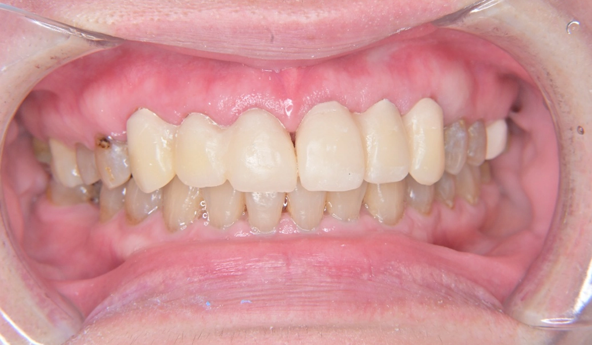 【ファーストプロビジョナルレストレーション】