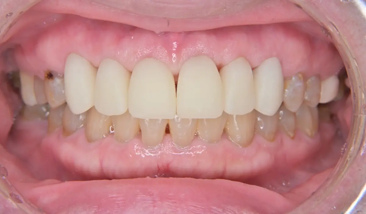 【セカンドプロビジョナルレストレーション】