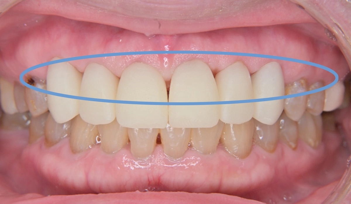 ブラックトライアングルとは？