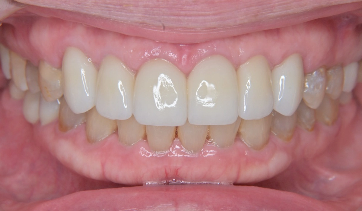 ブラックトライアングルとは？