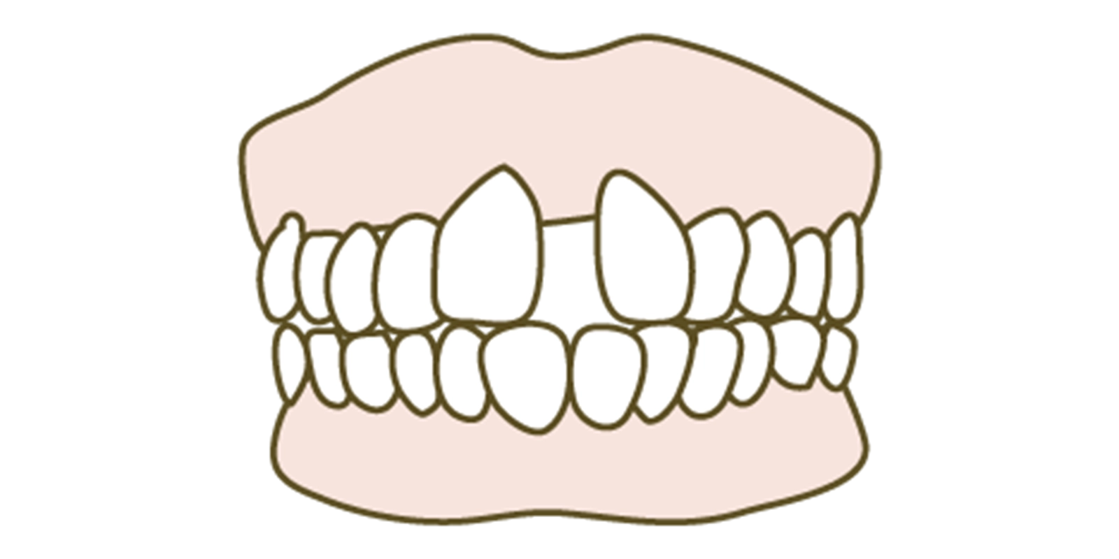 正中離開(せいちゅうりかい)とは？