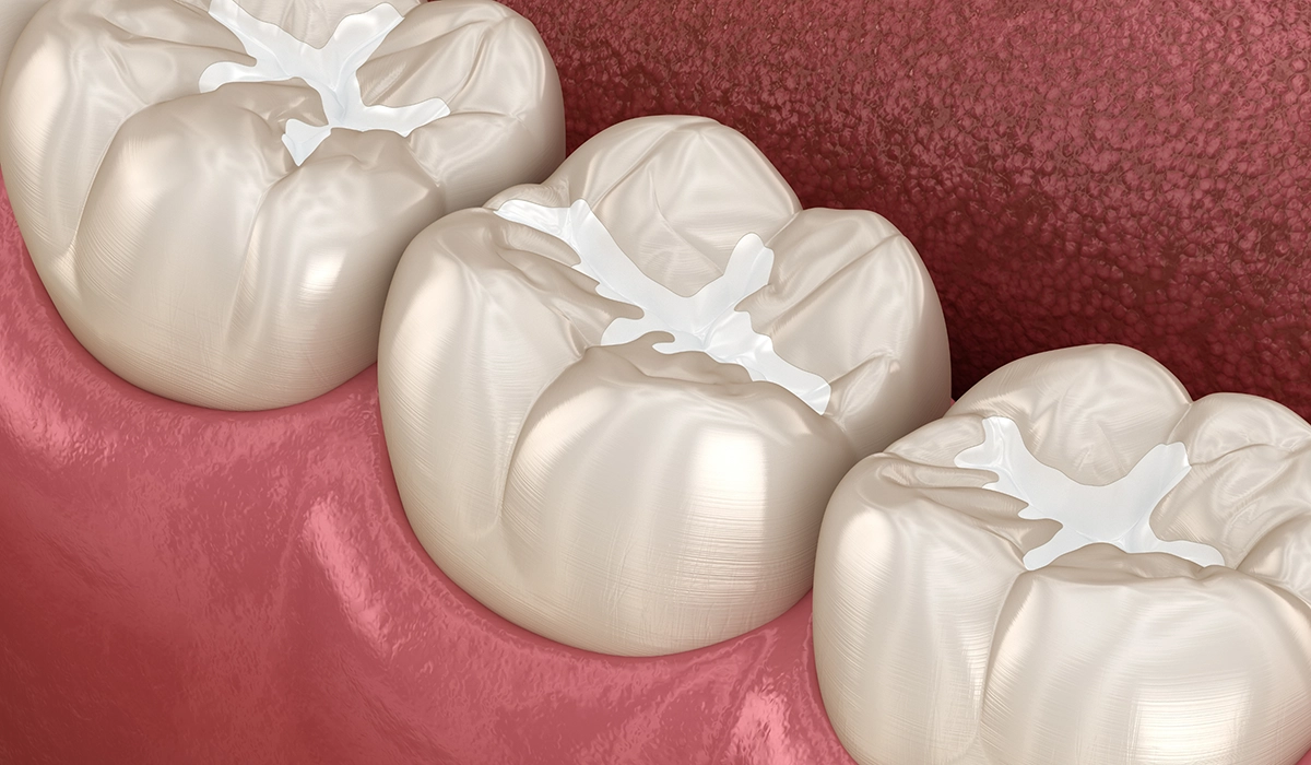 ダイレクトボンディング