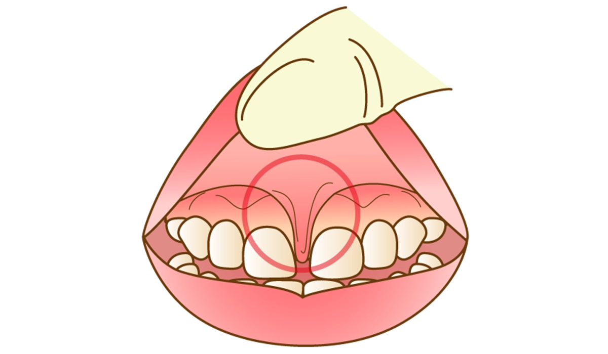 上唇小帯切除(必要な場合)