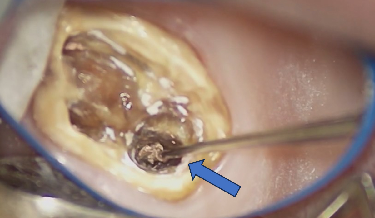 ガッタパーチャを除去する様子
